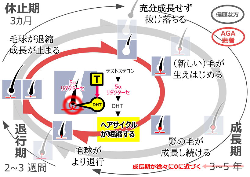 ヘアサイクル（AGA）