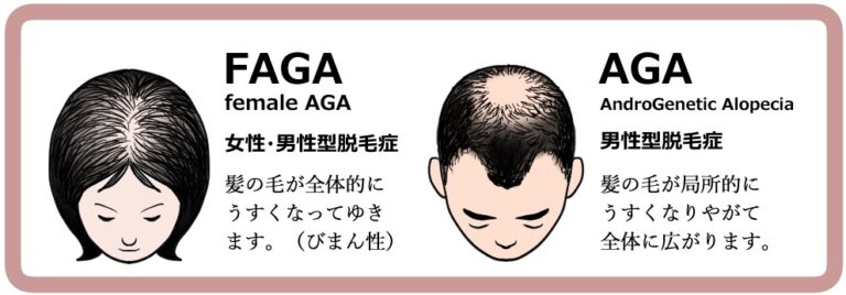 男女の脱毛症違い
